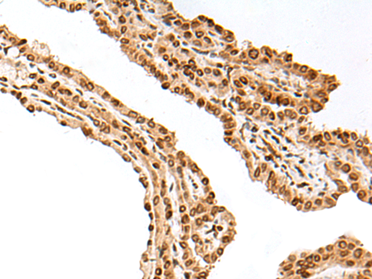 Immunohistochemistry of paraffin-embedded Human thyroid cancer tissue  using FANCB Polyclonal Antibody at dilution of 1:25(×200)