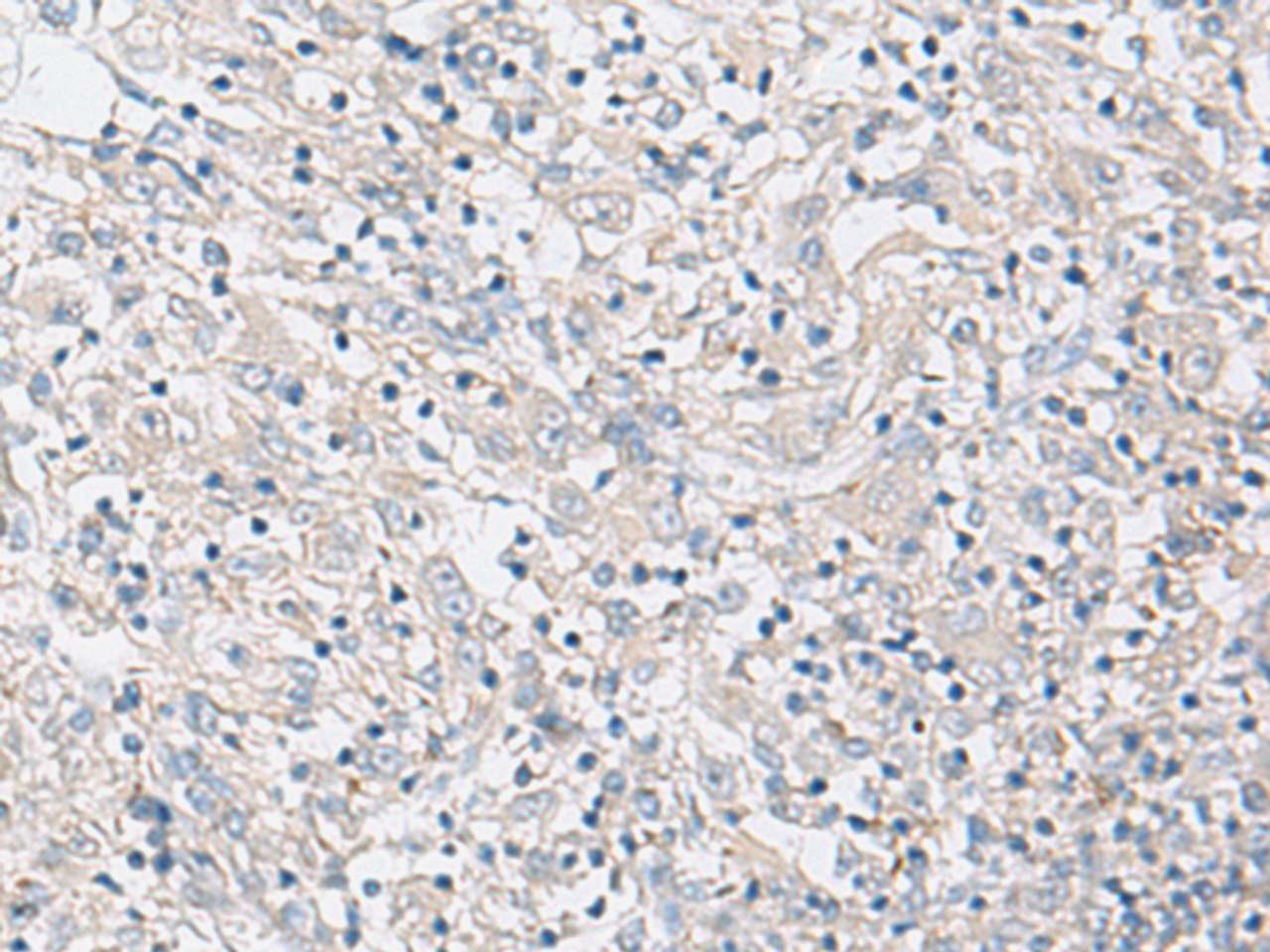 Immunohistochemistry of paraffin-embedded Human liver cancer tissue  using FBXO16 Polyclonal Antibody at dilution of 1:60(×200)