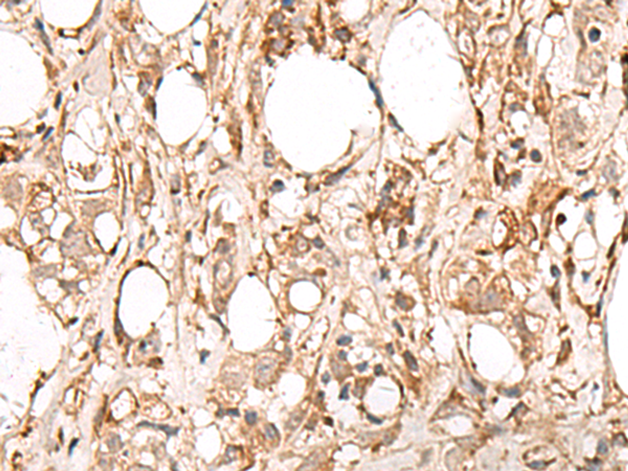 Immunohistochemistry of paraffin-embedded Human breast cancer tissue  using FBXW8 Polyclonal Antibody at dilution of 1:65(×200)