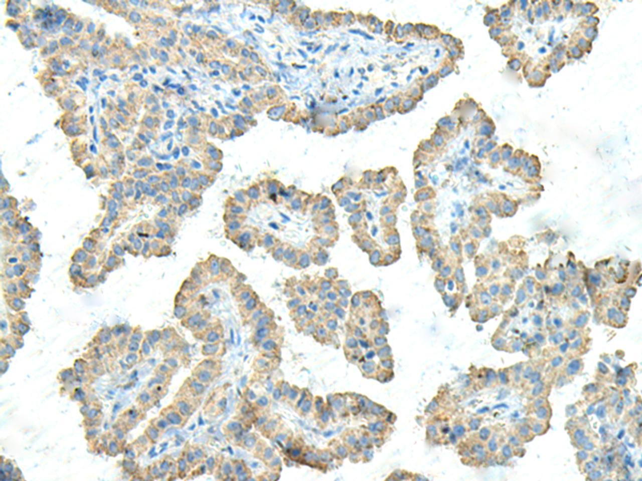 Immunohistochemistry of paraffin-embedded Human thyroid cancer tissue  using FCGRT Polyclonal Antibody at dilution of 1:45(×200)