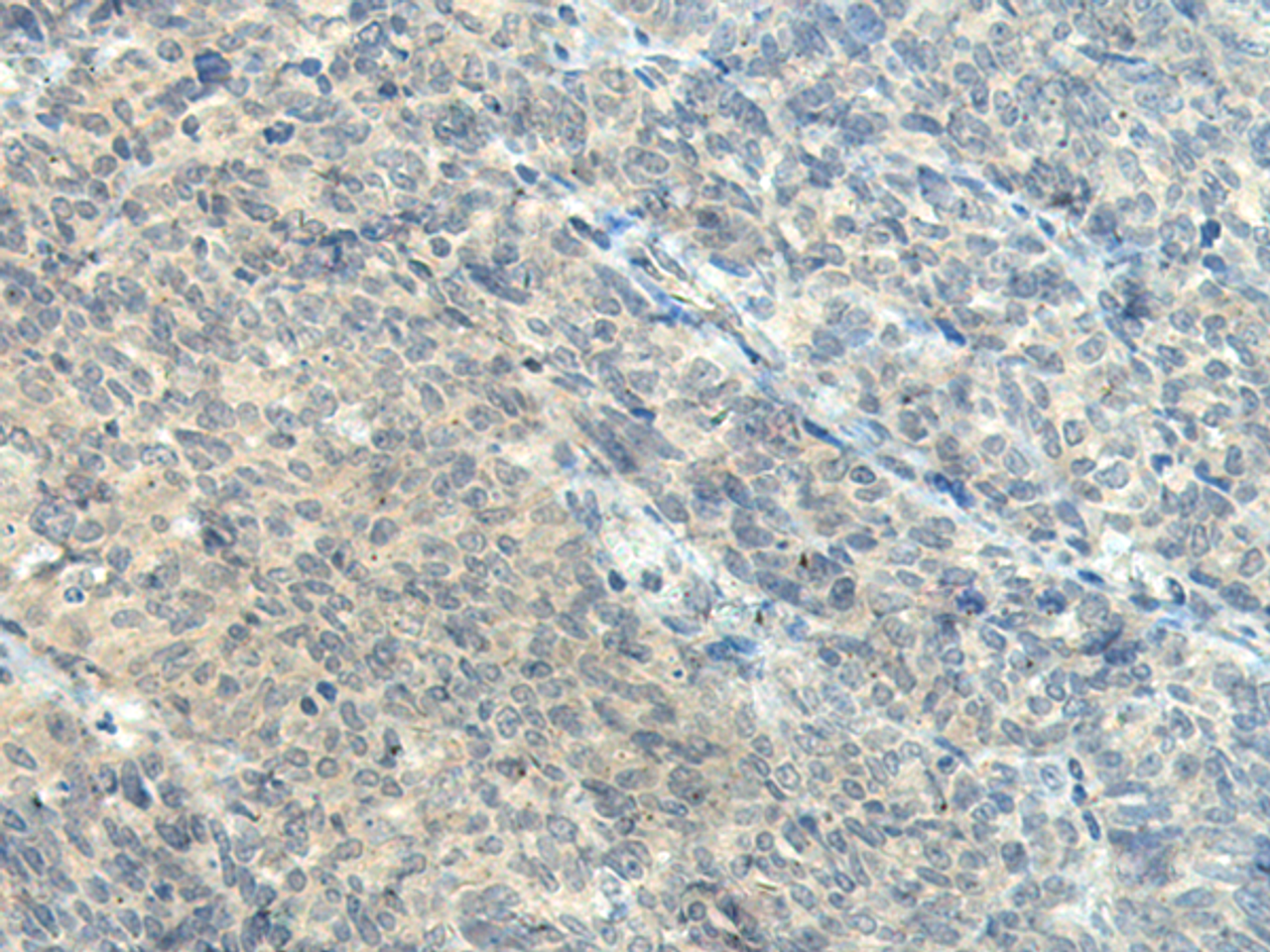 Immunohistochemistry of paraffin-embedded Human ovarian cancer tissue  using CTDP1 Polyclonal Antibody at dilution of 1:55(×200)