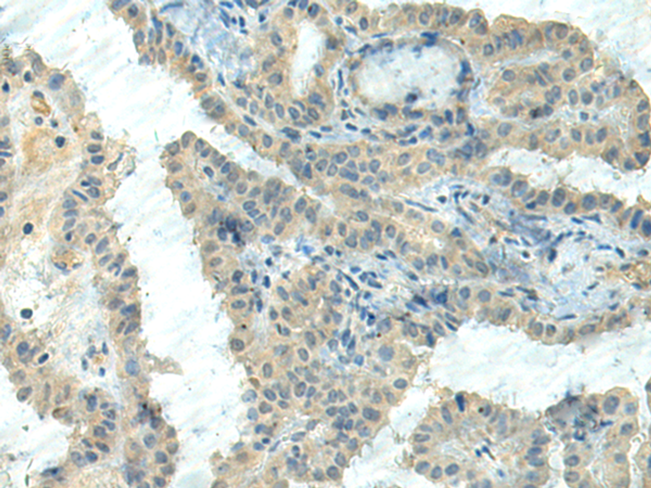 Immunohistochemistry of paraffin-embedded Human thyroid cancer tissue  using CTDP1 Polyclonal Antibody at dilution of 1:55(×200)