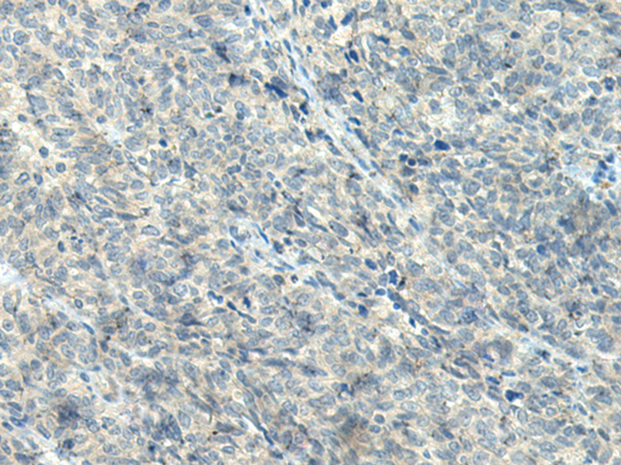 Immunohistochemistry of paraffin-embedded Human ovarian cancer tissue  using NPVF Polyclonal Antibody at dilution of 1:80(×200)