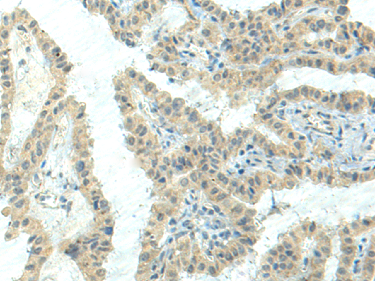 Immunohistochemistry of paraffin-embedded Human thyroid cancer tissue  using NPVF Polyclonal Antibody at dilution of 1:80(×200)