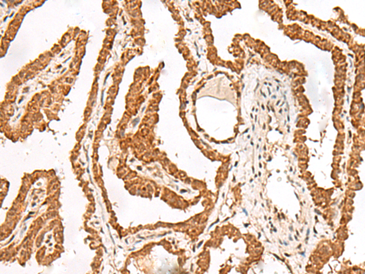 Immunohistochemistry of paraffin-embedded Human thyroid cancer tissue  using FER Polyclonal Antibody at dilution of 1:90(×200)