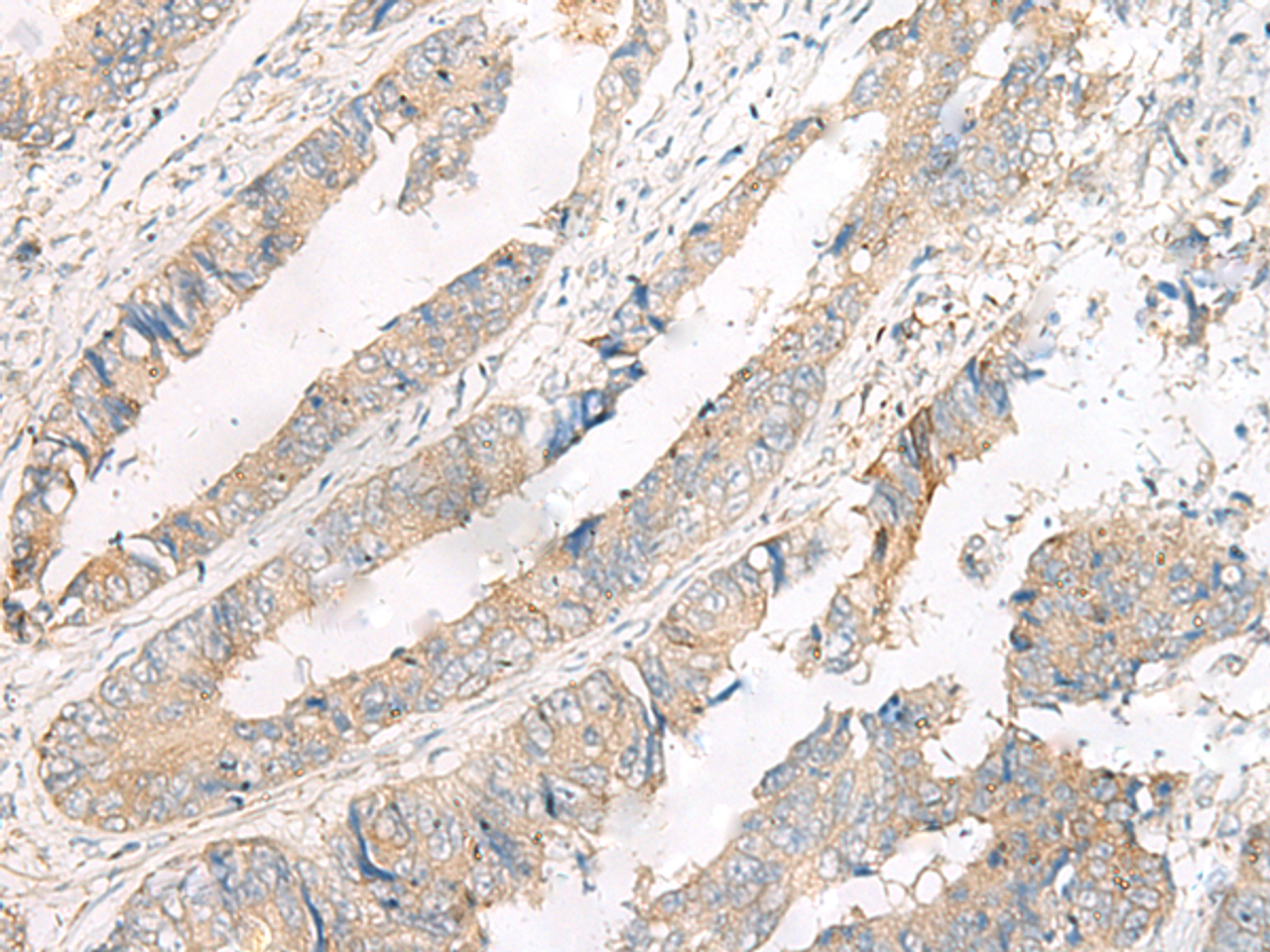 Immunohistochemistry of paraffin-embedded Human colorectal cancer tissue  using FERD3L Polyclonal Antibody at dilution of 1:75(×200)
