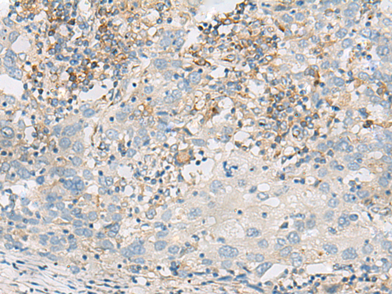 Immunohistochemistry of paraffin-embedded Human cervical cancer tissue  using FERD3L Polyclonal Antibody at dilution of 1:75(×200)