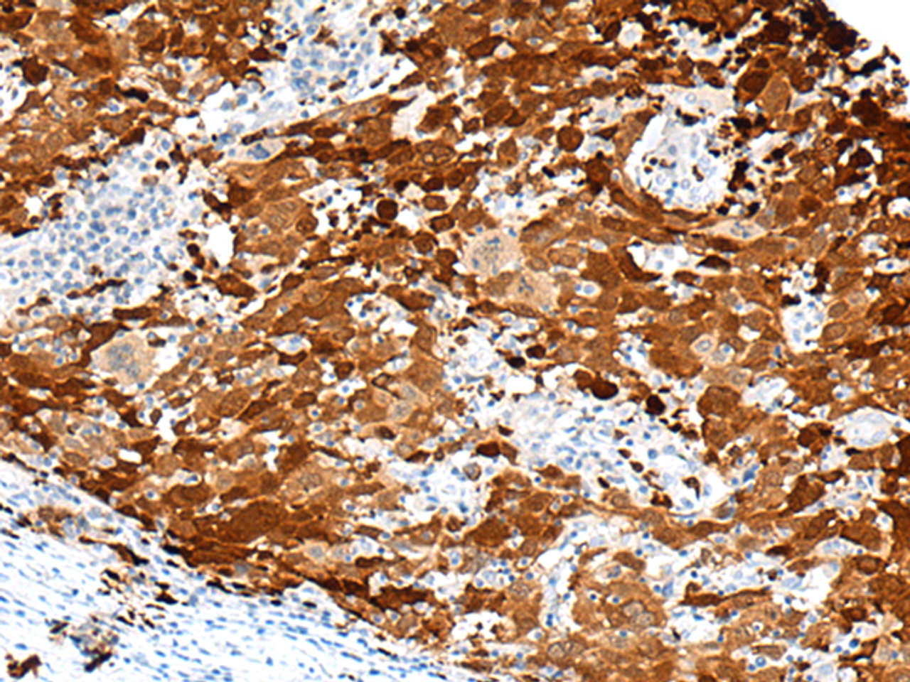 Immunohistochemistry of paraffin-embedded Human cervical cancer tissue  using FGD3 Polyclonal Antibody at dilution of 1:50(×200)
