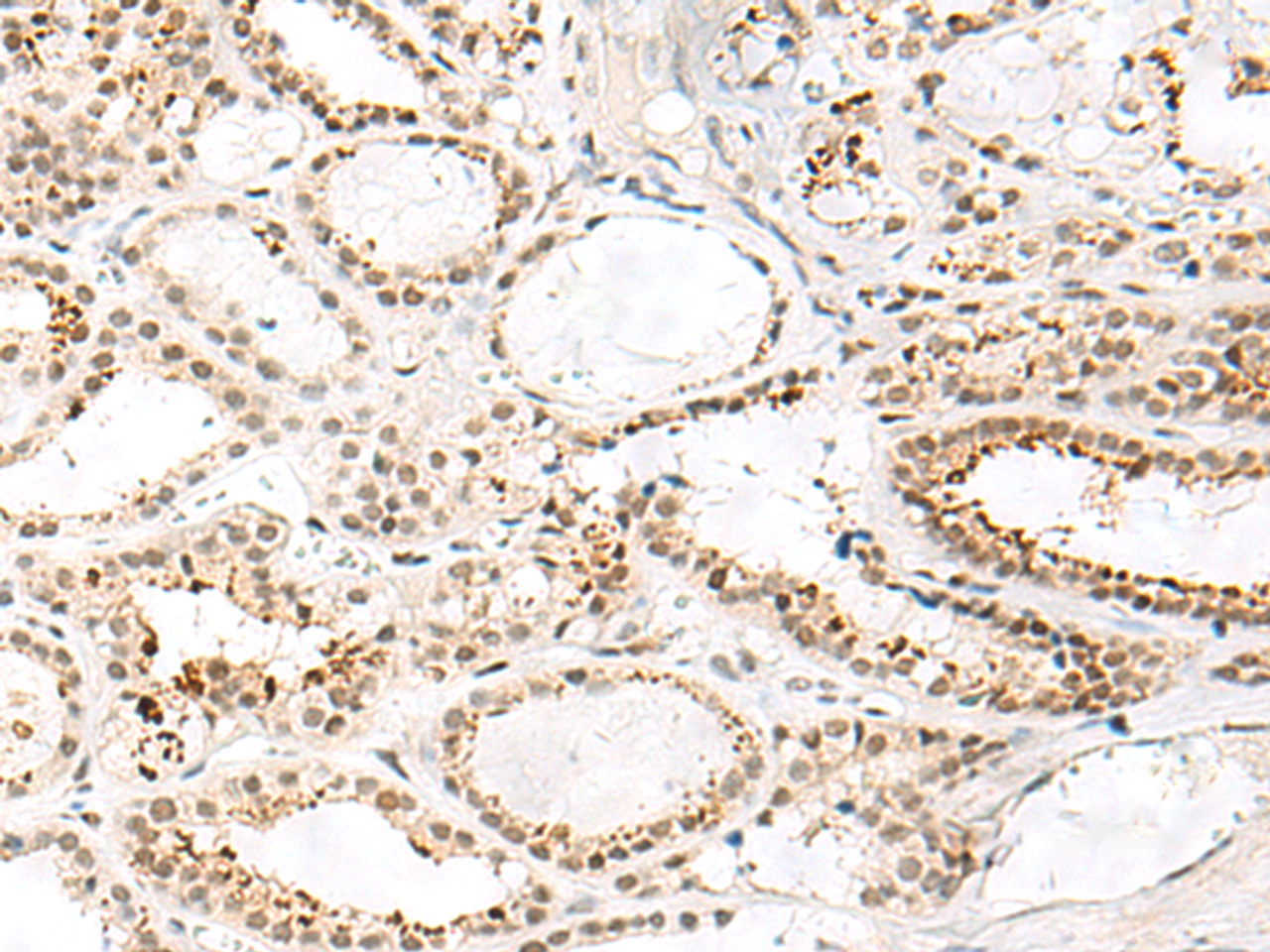 Immunohistochemistry of paraffin-embedded Human thyroid cancer tissue  using FKBP5 Polyclonal Antibody at dilution of 1:50(×200)