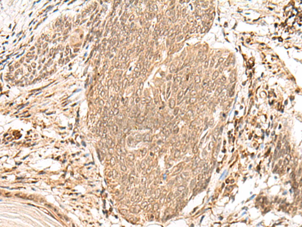 Immunohistochemistry of paraffin-embedded Human esophagus cancer tissue  using VPS50 Polyclonal Antibody at dilution of 1:45(×200)