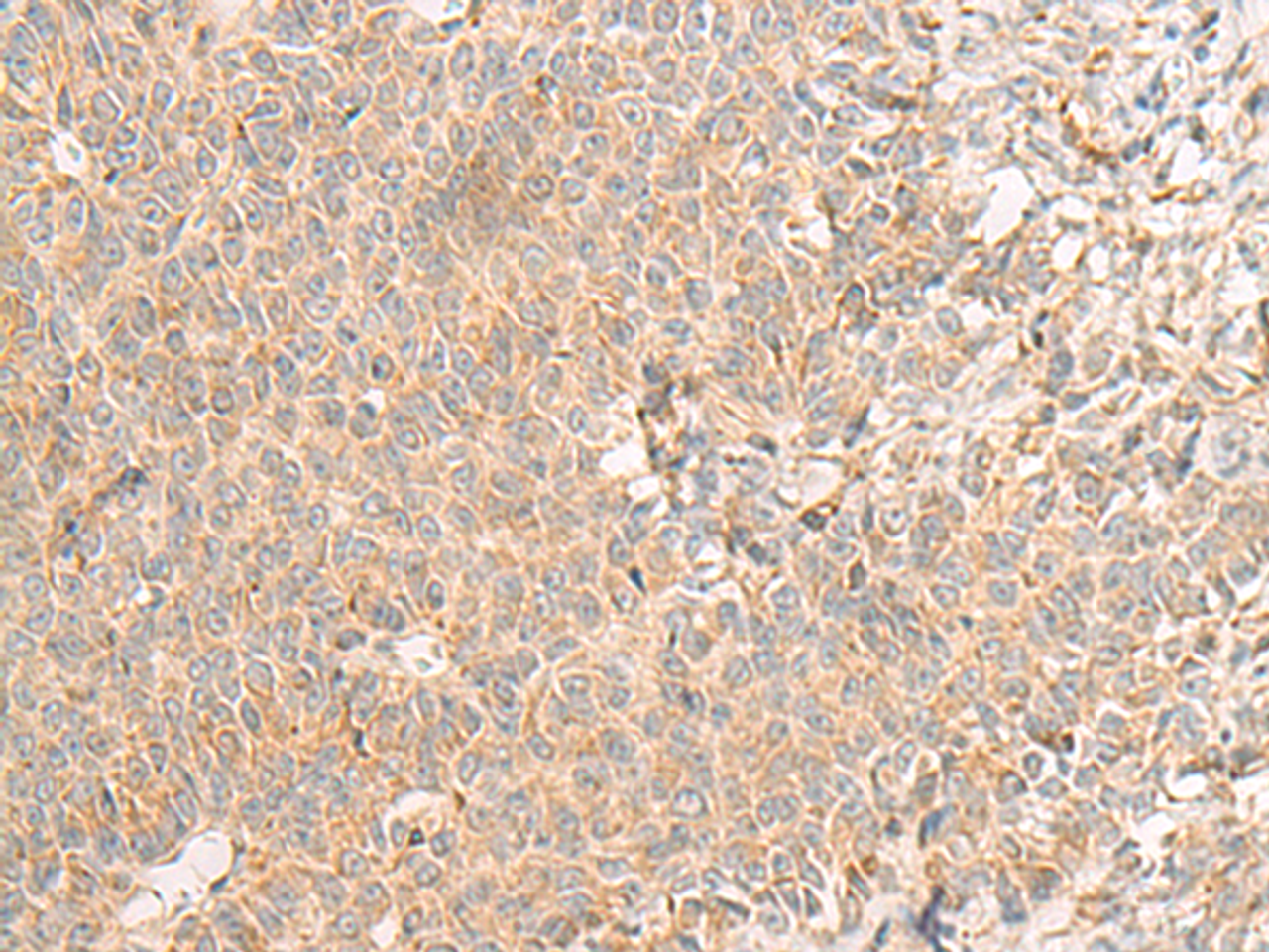 Immunohistochemistry of paraffin-embedded Human ovarian cancer tissue  using RNF207 Polyclonal Antibody at dilution of 1:40(×200)