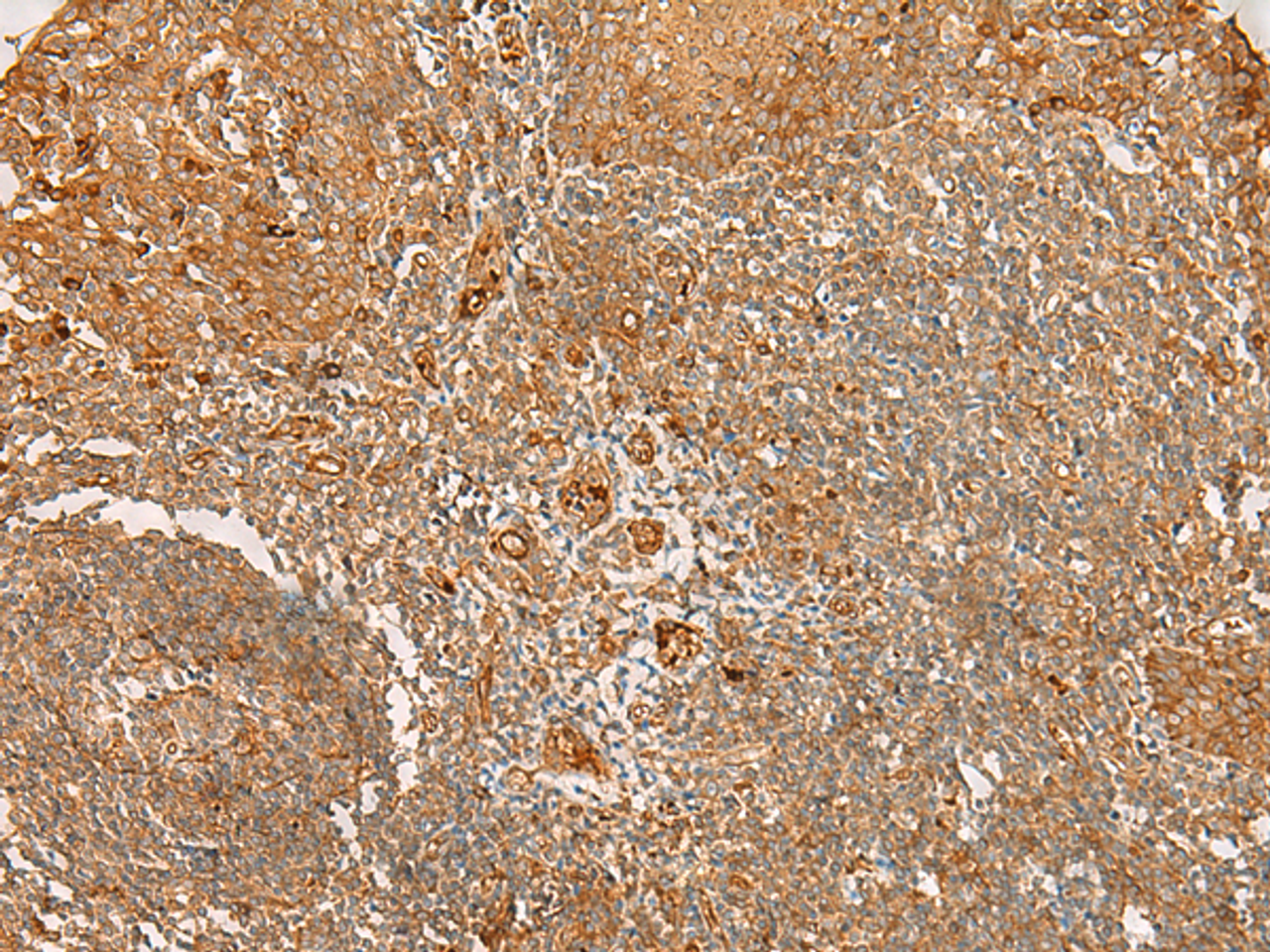 Immunohistochemistry of paraffin-embedded Human tonsil tissue  using FLNC Polyclonal Antibody at dilution of 1:30(×200)