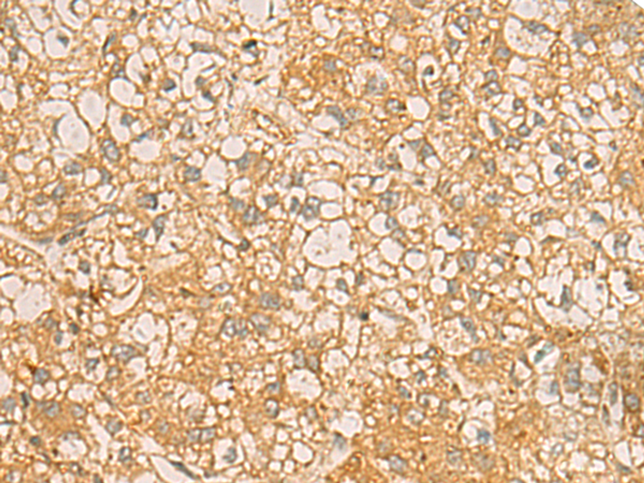 Immunohistochemistry of paraffin-embedded Human liver cancer tissue  using FAAP100 Polyclonal Antibody at dilution of 1:50(×200)
