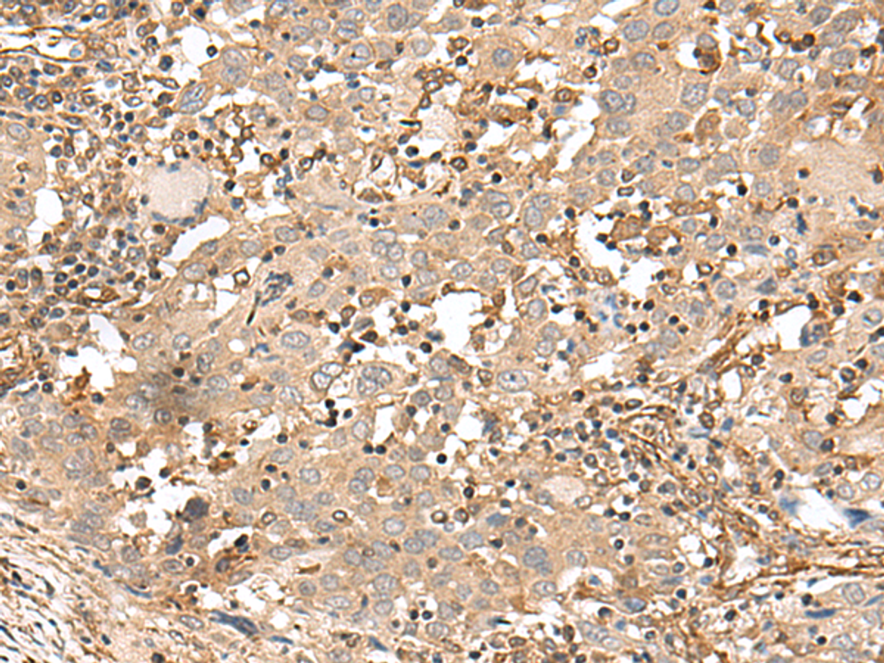 Immunohistochemistry of paraffin-embedded Human cervical cancer tissue  using FSTL5 Polyclonal Antibody at dilution of 1:50(×200)