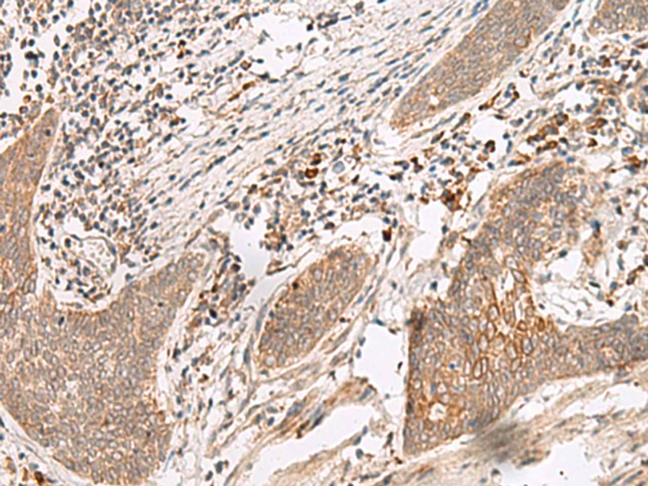 Immunohistochemistry of paraffin-embedded Human esophagus cancer tissue  using FUT10 Polyclonal Antibody at dilution of 1:45(×200)