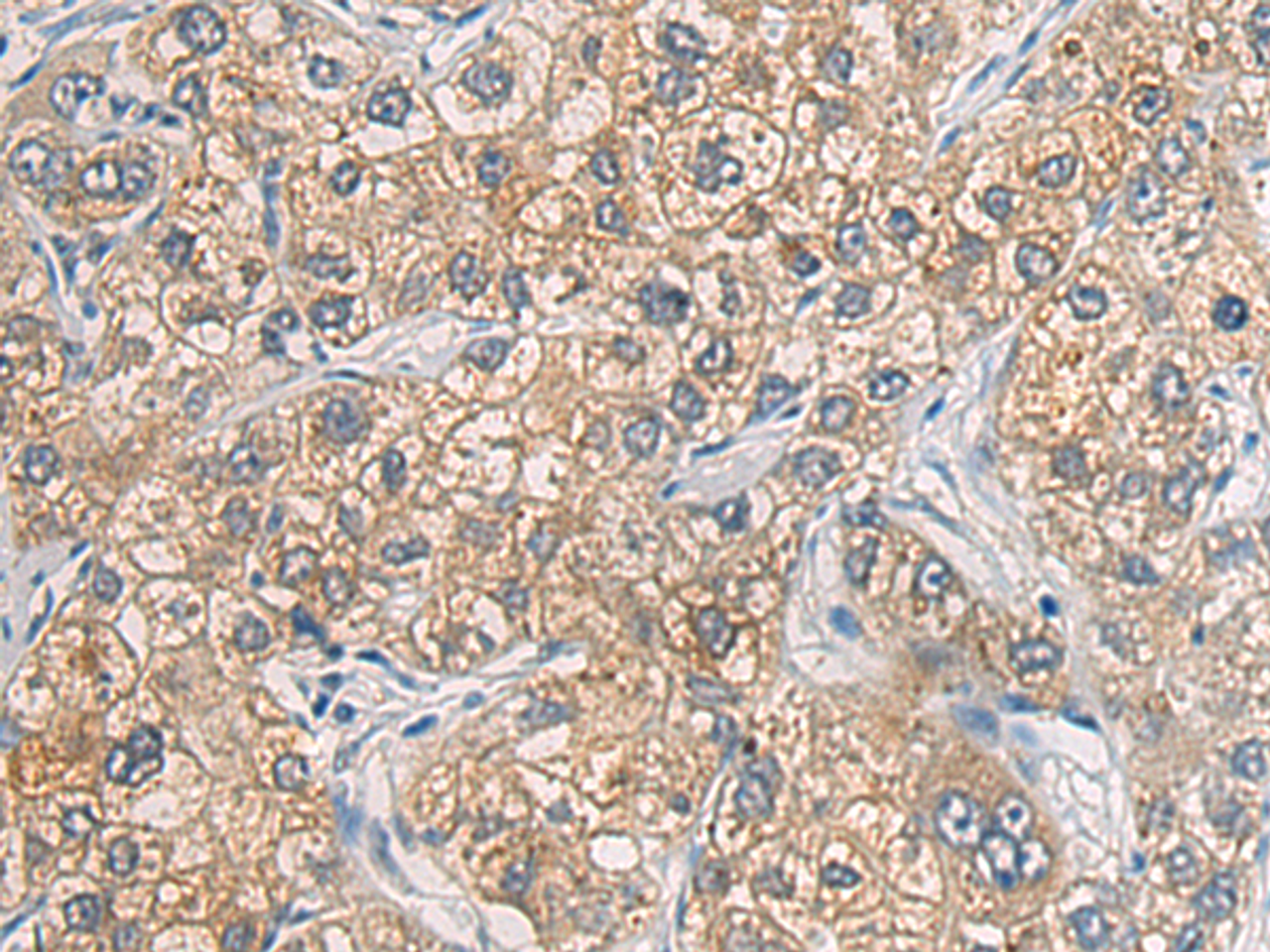 Immunohistochemistry of paraffin-embedded Human liver cancer tissue  using GAB4 Polyclonal Antibody at dilution of 1:60(×200)