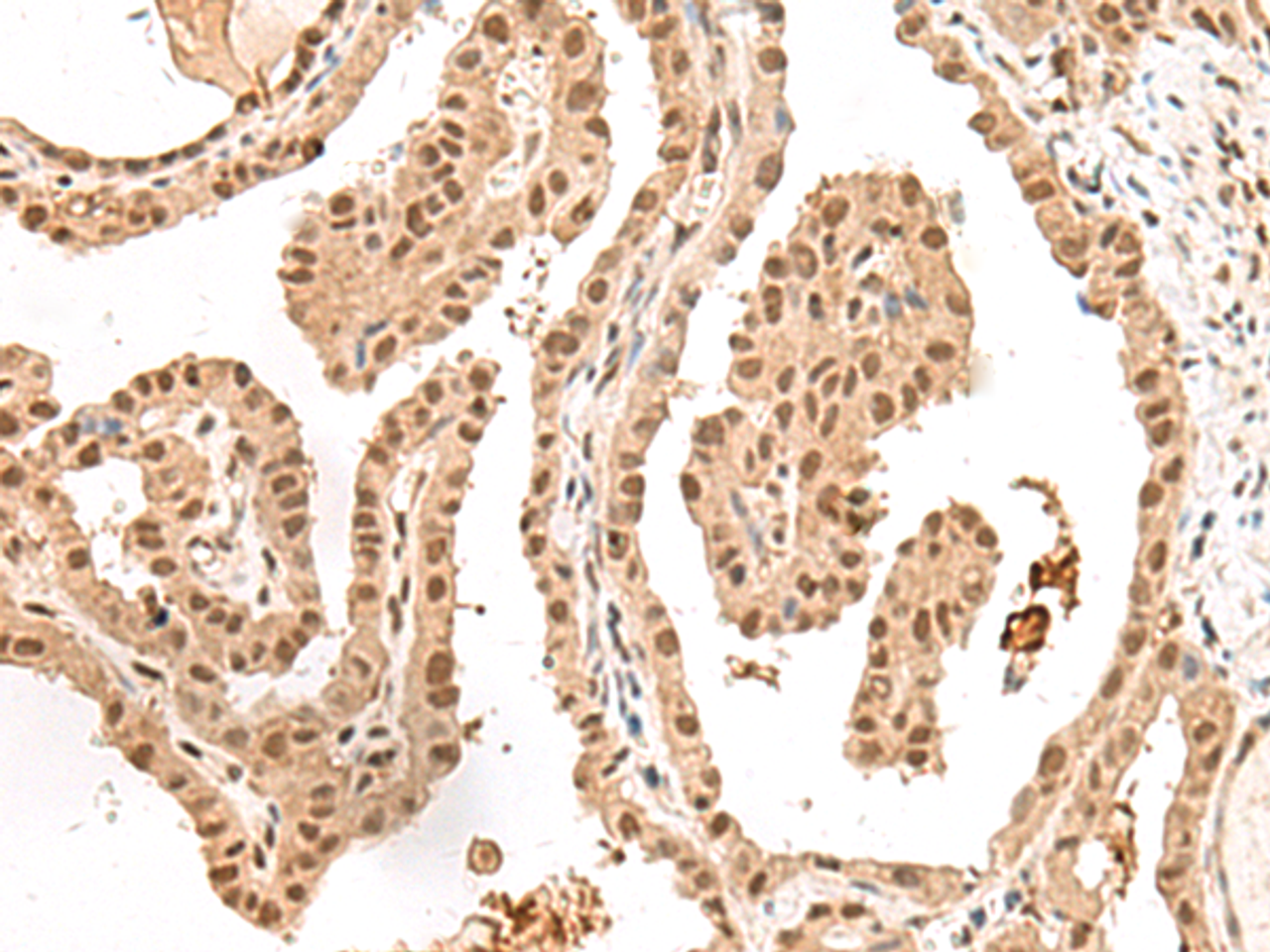 Immunohistochemistry of paraffin-embedded Human thyroid cancer tissue  using LGALS4 Polyclonal Antibody at dilution of 1:30(×200)