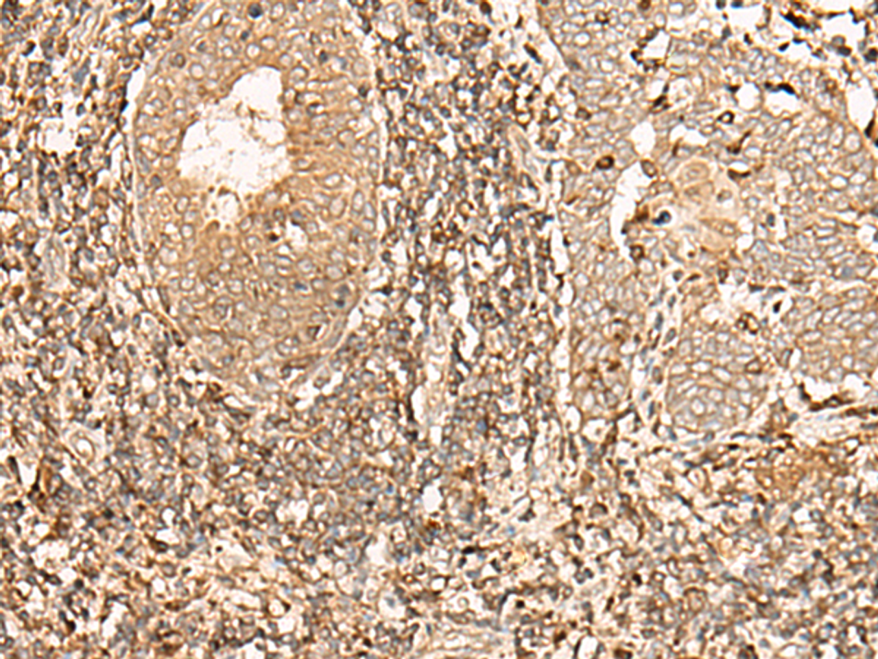 Immunohistochemistry of paraffin-embedded Human esophagus cancer tissue  using GALR2 Polyclonal Antibody at dilution of 1:40(×200)