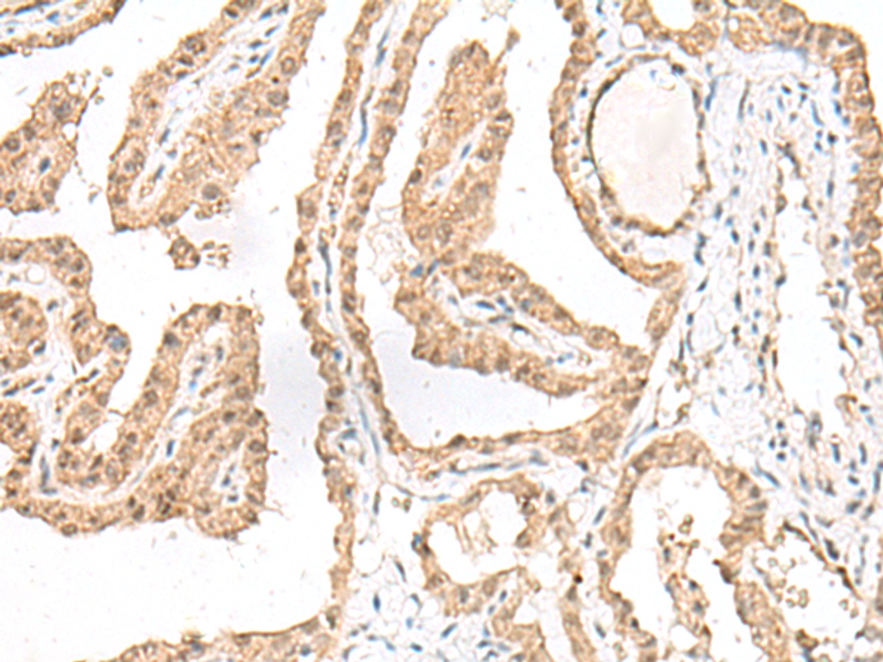 Immunohistochemistry of paraffin-embedded Human thyroid cancer tissue  using RALGAPA1 Polyclonal Antibody at dilution of 1:55(×200)