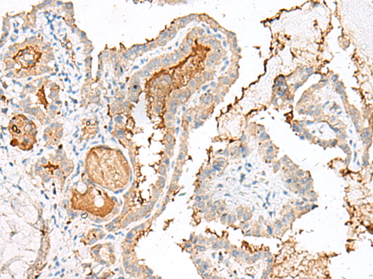 Immunohistochemistry of paraffin-embedded Human thyroid cancer tissue  using GARNL3 Polyclonal Antibody at dilution of 1:60(×200)