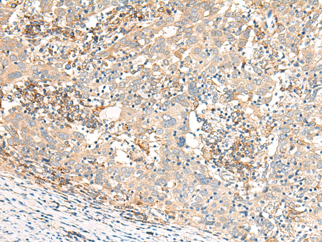 Immunohistochemistry of paraffin-embedded Human cervical cancer tissue  using GBP4 Polyclonal Antibody at dilution of 1:30(×200)