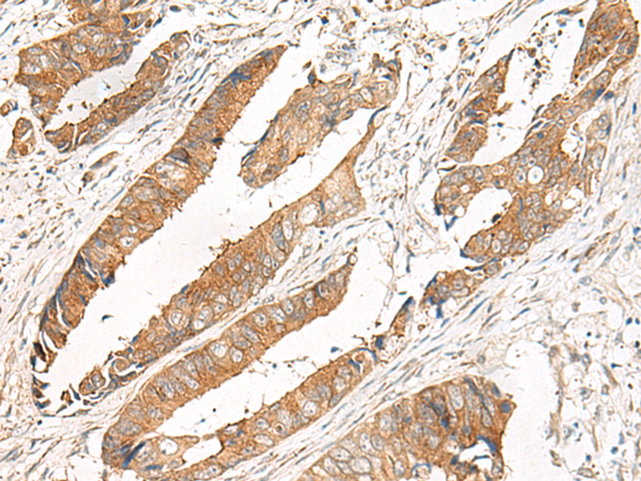 Immunohistochemistry of paraffin-embedded Human colorectal cancer tissue  using GBP4 Polyclonal Antibody at dilution of 1:30(×200)