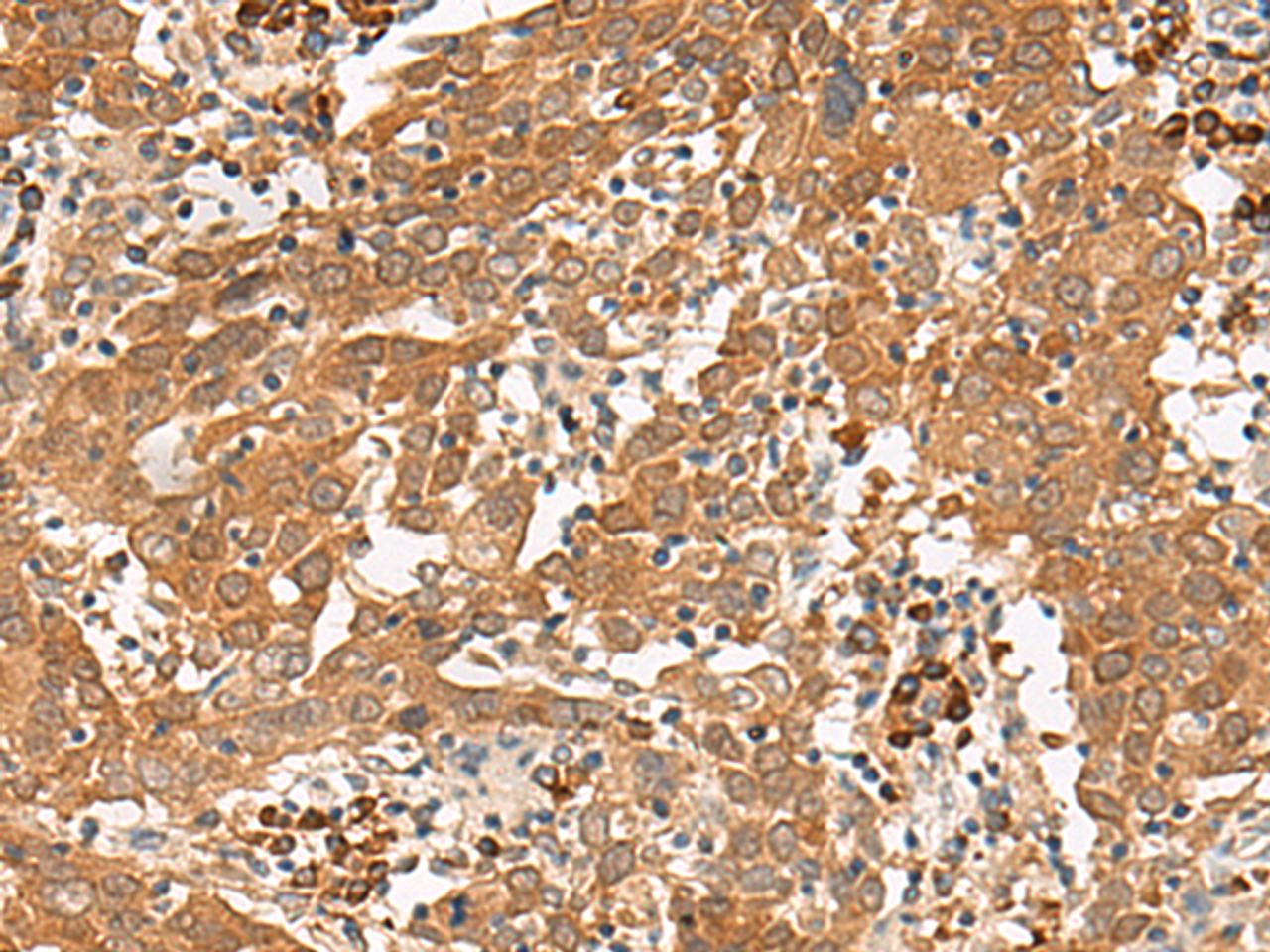 Immunohistochemistry of paraffin-embedded Human cervical cancer tissue  using GFI1 Polyclonal Antibody at dilution of 1:100(×200)
