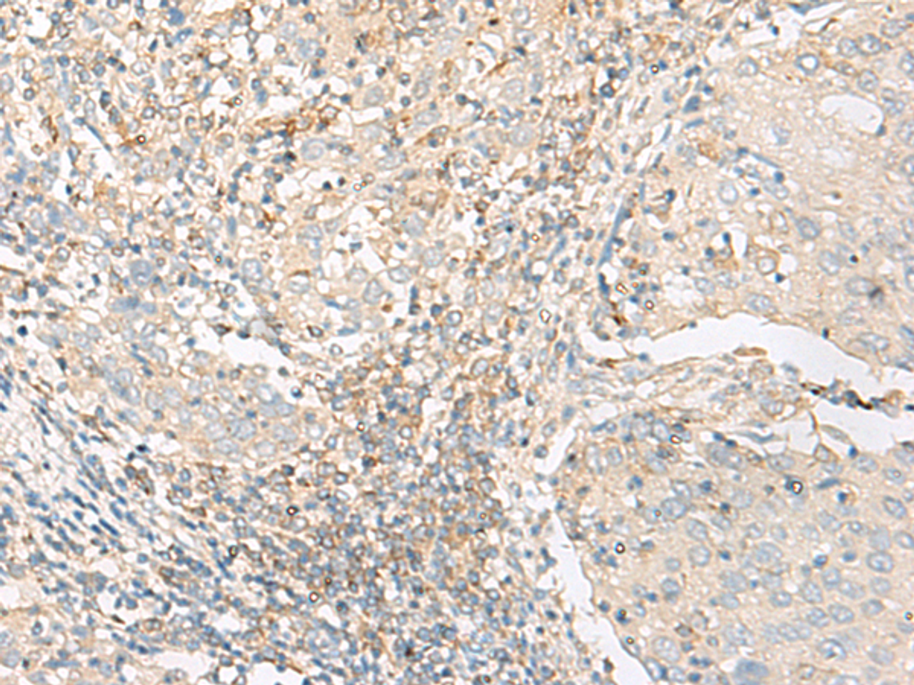 Immunohistochemistry of paraffin-embedded Human cervical cancer tissue  using GLIS1 Polyclonal Antibody at dilution of 1:50(×200)