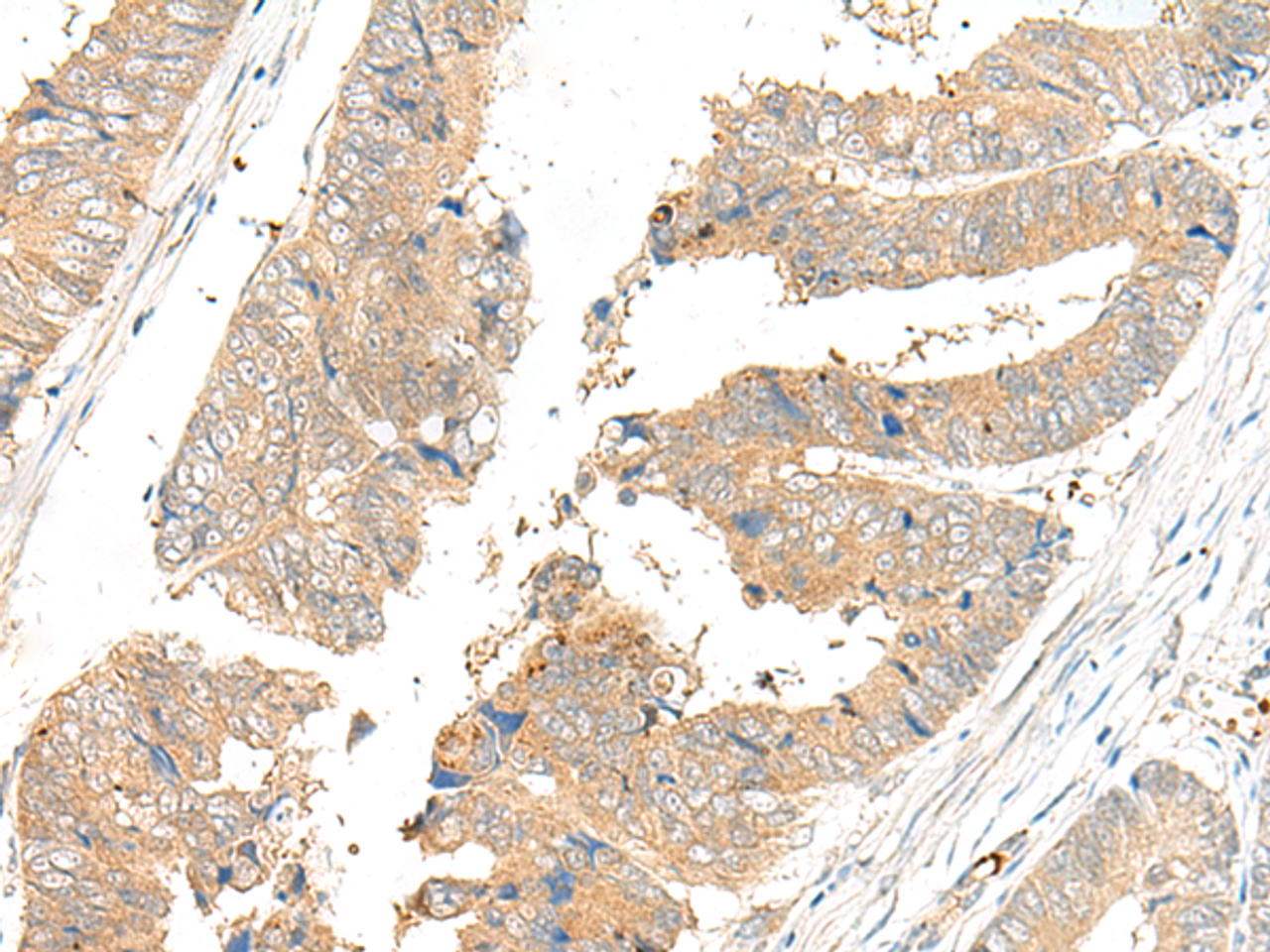 Immunohistochemistry of paraffin-embedded Human colorectal cancer tissue  using GLS2 Polyclonal Antibody at dilution of 1:45(×200)