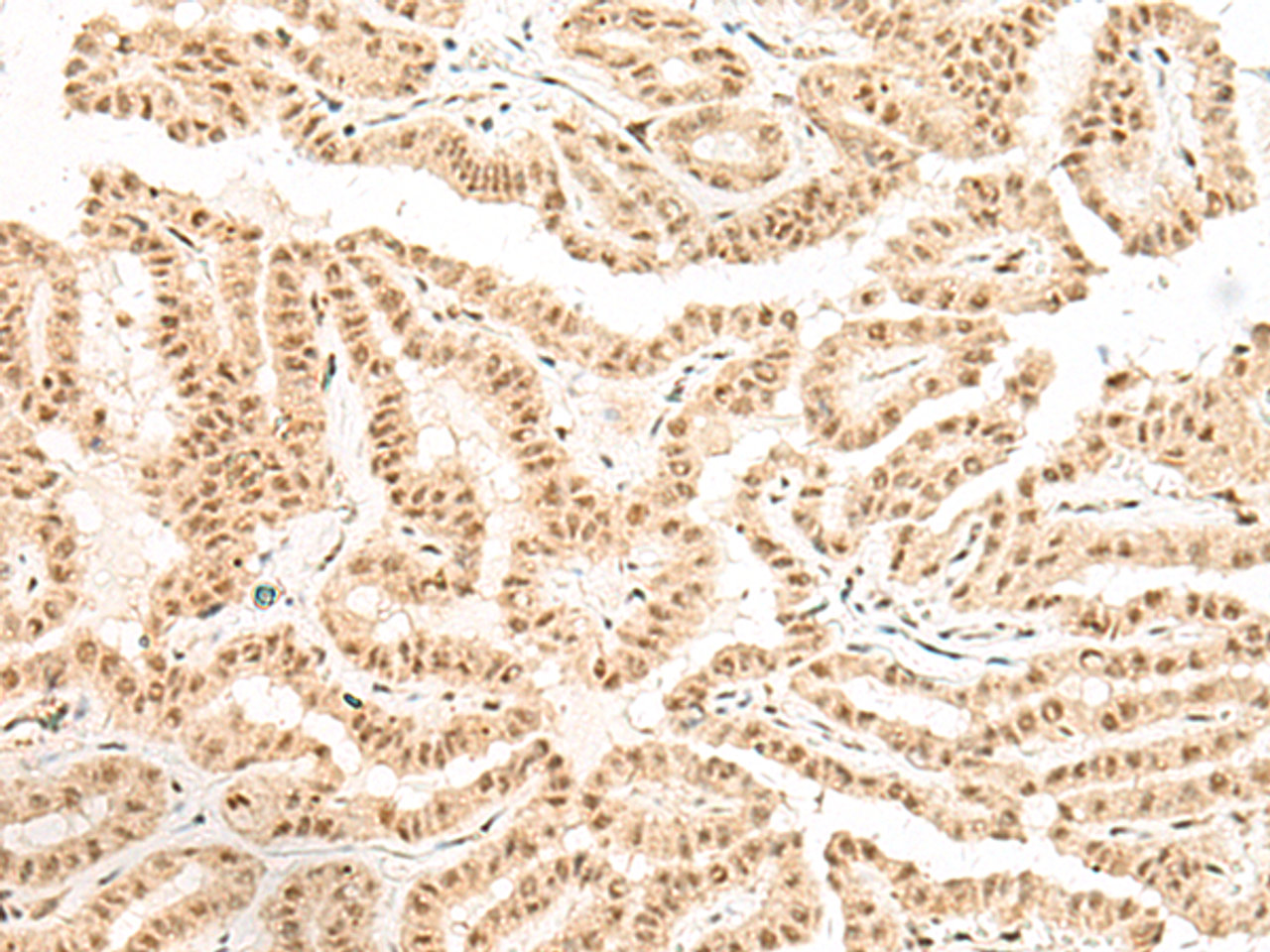 Immunohistochemistry of paraffin-embedded Human thyroid cancer tissue  using BICRA Polyclonal Antibody at dilution of 1:40(×200)