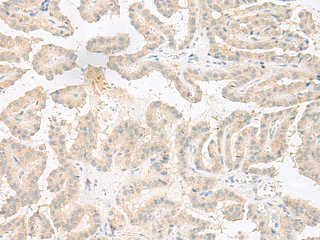 Immunohistochemistry of paraffin-embedded Human thyroid cancer tissue  using EPRS Polyclonal Antibody at dilution of 1:60(×200)