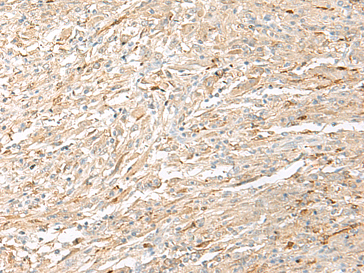 Immunohistochemistry of paraffin-embedded Human liver cancer tissue  using EPRS Polyclonal Antibody at dilution of 1:60(×200)