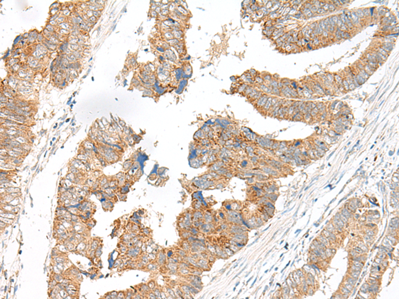 Immunohistochemistry of paraffin-embedded Human colorectal cancer tissue  using SLC6A9 Polyclonal Antibody at dilution of 1:25(×200)