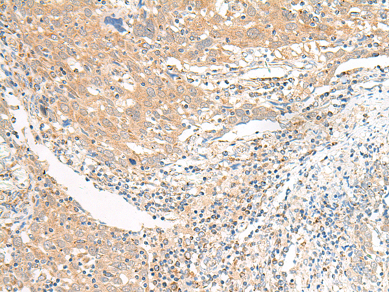 Immunohistochemistry of paraffin-embedded Human cervical cancer tissue  using SLC6A9 Polyclonal Antibody at dilution of 1:25(×200)