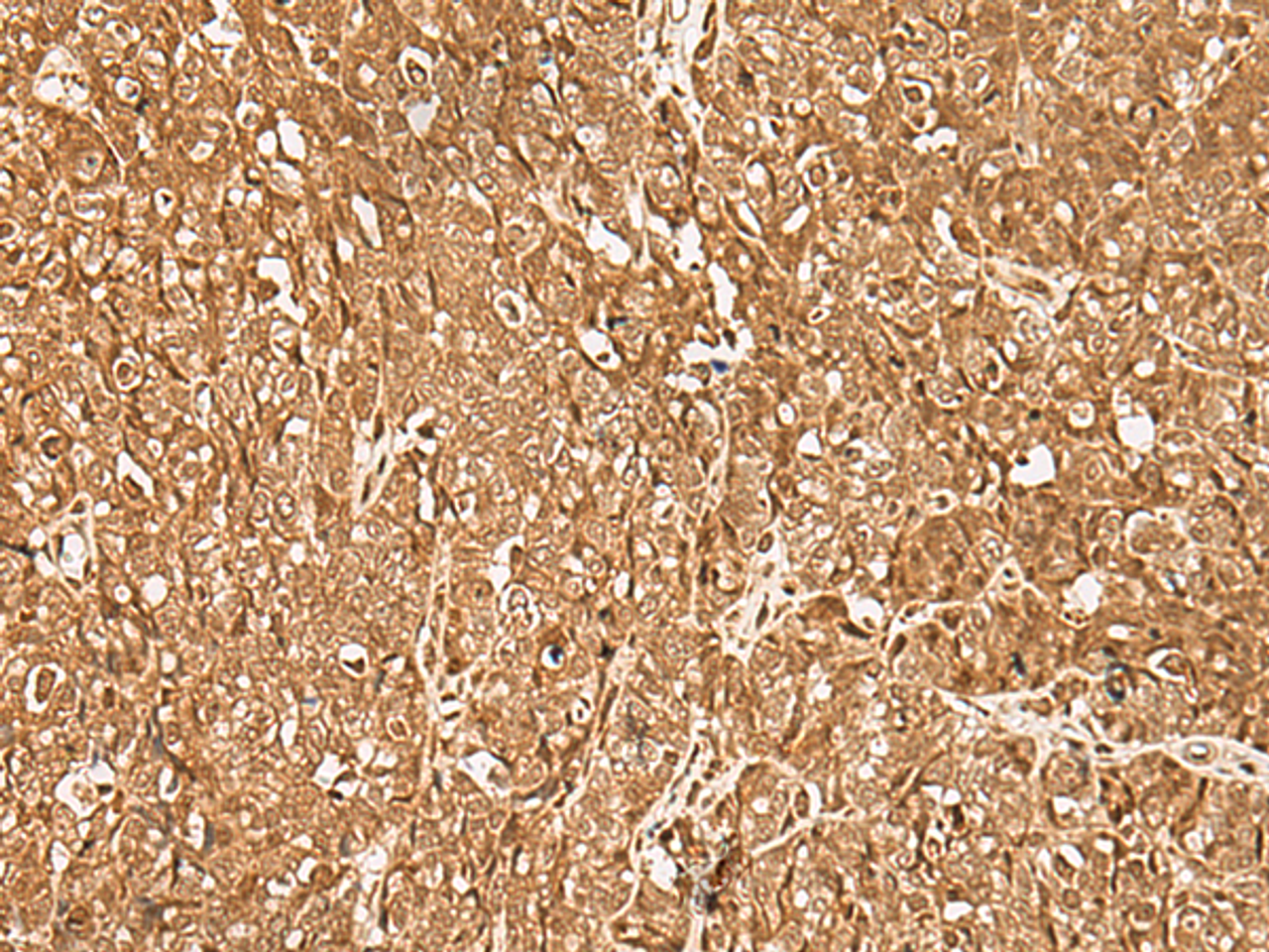 Immunohistochemistry of paraffin-embedded Human ovarian cancer tissue  using GMEB2 Polyclonal Antibody at dilution of 1:35(×200)