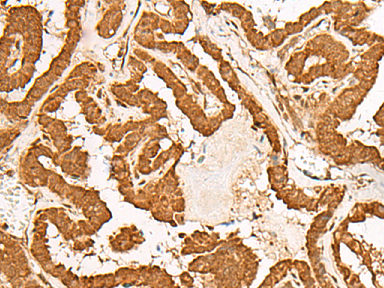 Immunohistochemistry of paraffin-embedded Human thyroid cancer tissue  using GMEB2 Polyclonal Antibody at dilution of 1:35(×200)