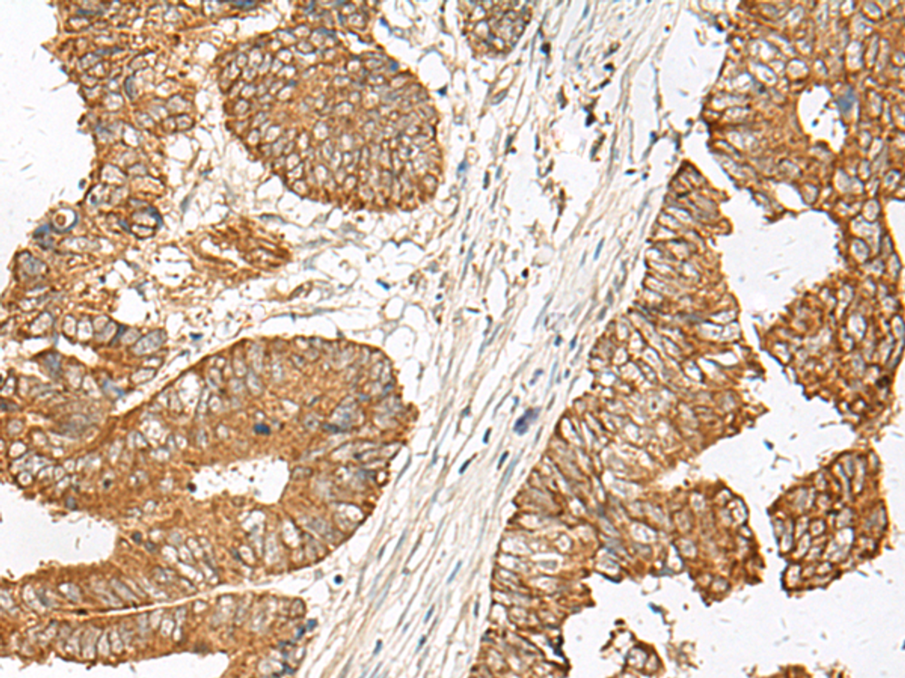 Immunohistochemistry of paraffin-embedded Human colorectal cancer tissue  using GNAT1 Polyclonal Antibody at dilution of 1:25(×200)