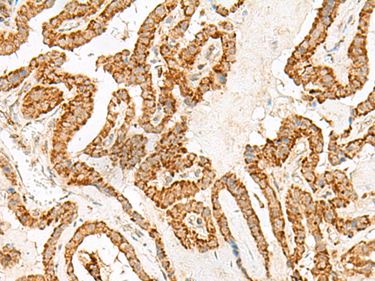 Immunohistochemistry of paraffin-embedded Human thyroid cancer tissue  using NUP210 Polyclonal Antibody at dilution of 1:30(×200)