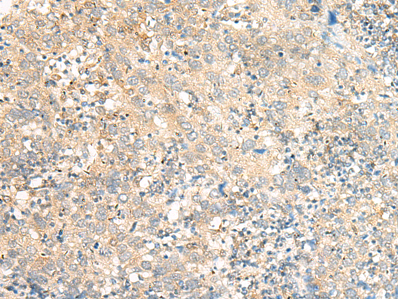 Immunohistochemistry of paraffin-embedded Human cervical cancer tissue  using C5AR2 Polyclonal Antibody at dilution of 1:25(×200)
