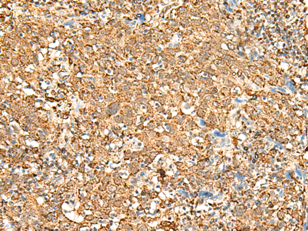 Immunohistochemistry of paraffin-embedded Human cervical cancer tissue  using P2RY14 Polyclonal Antibody at dilution of 1:25(×200)