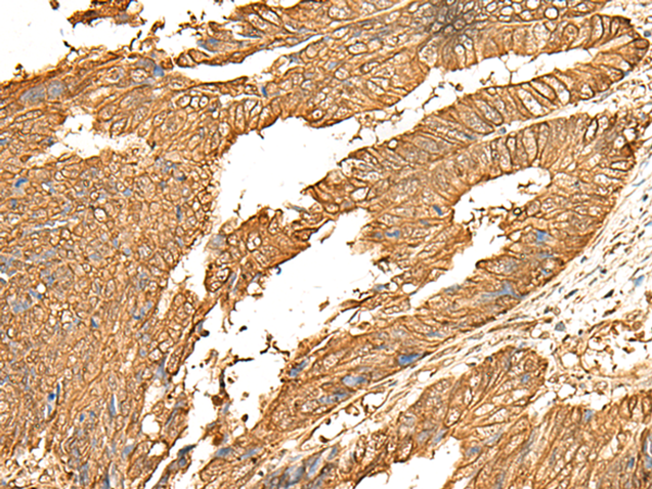 Immunohistochemistry of paraffin-embedded Human colorectal cancer tissue  using P2RY14 Polyclonal Antibody at dilution of 1:25(×200)