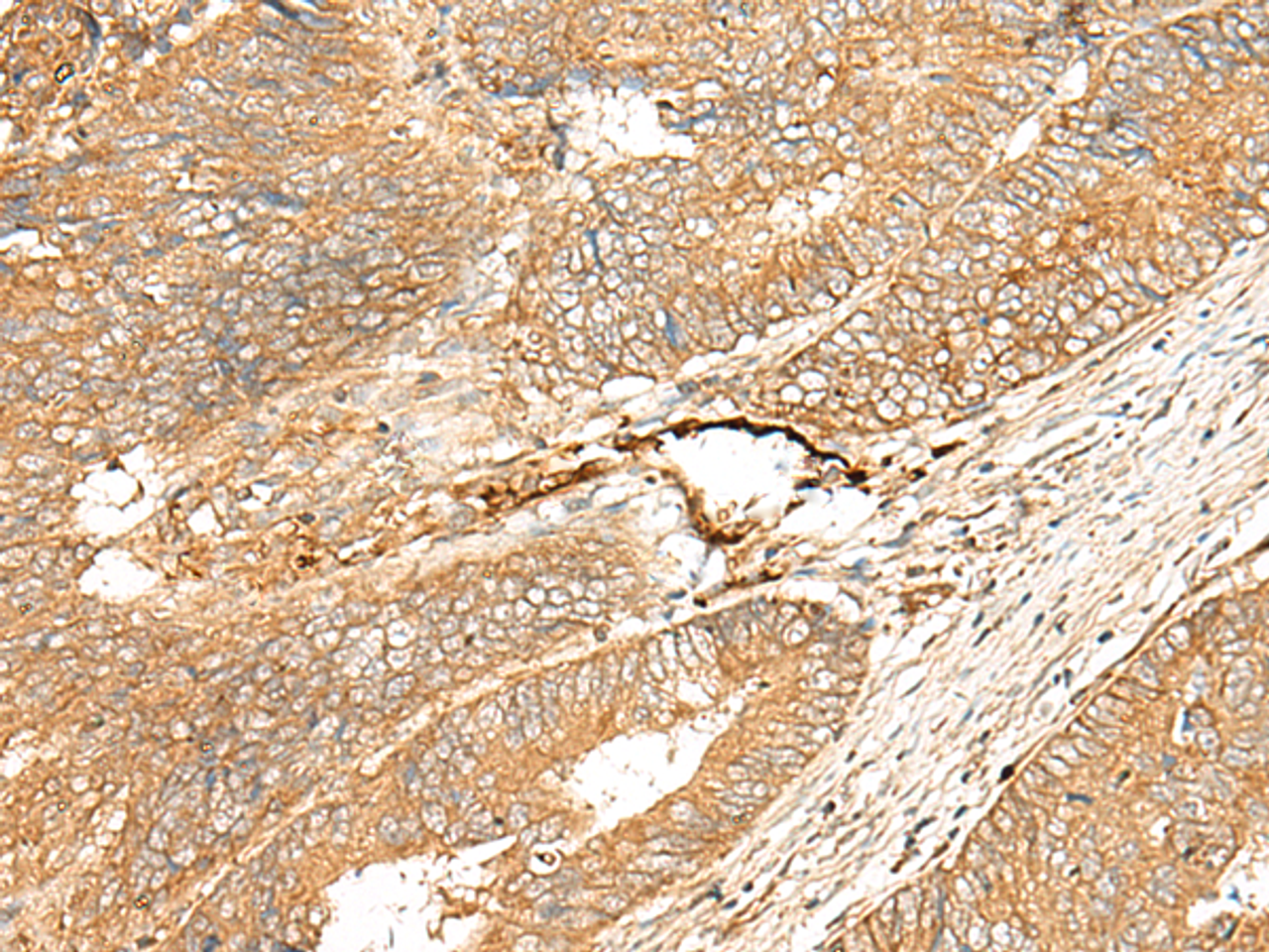 Immunohistochemistry of paraffin-embedded Human colorectal cancer tissue  using ADGRF5 Polyclonal Antibody at dilution of 1:40(×200)