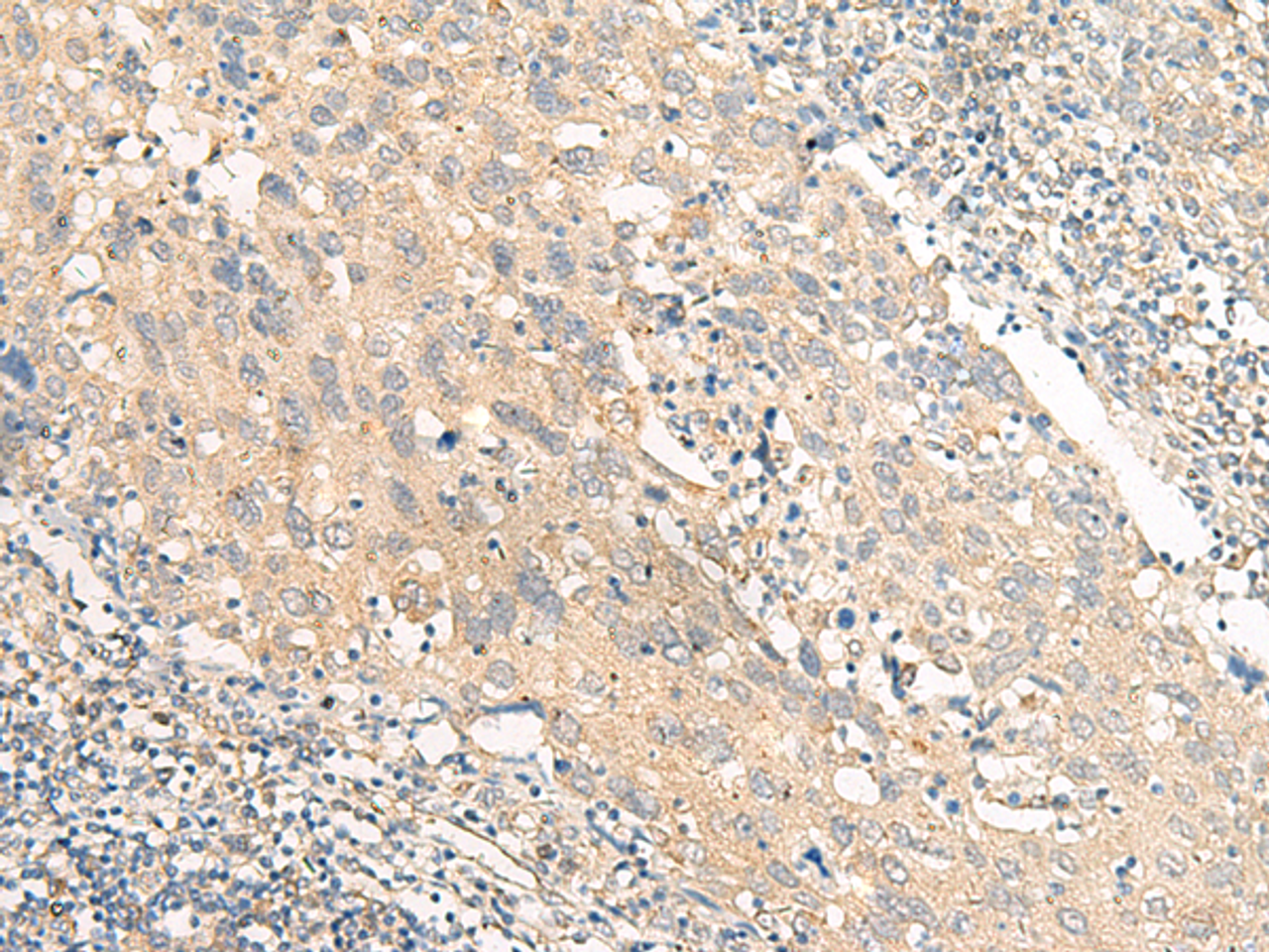 Immunohistochemistry of paraffin-embedded Human cervical cancer tissue  using CHP1 Polyclonal Antibody at dilution of 1:25(×200)