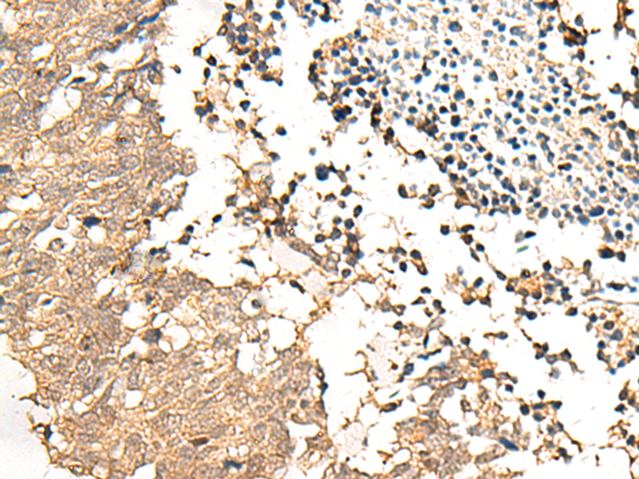Immunohistochemistry of paraffin-embedded Human lung cancer tissue  using CHP1 Polyclonal Antibody at dilution of 1:25(×200)