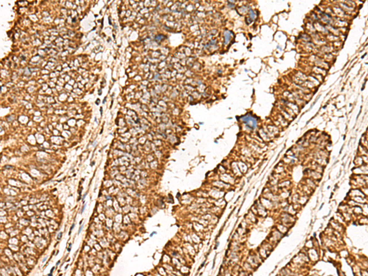 Immunohistochemistry of paraffin-embedded Human colorectal cancer tissue  using ATP5I Polyclonal Antibody at dilution of 1:65(×200)