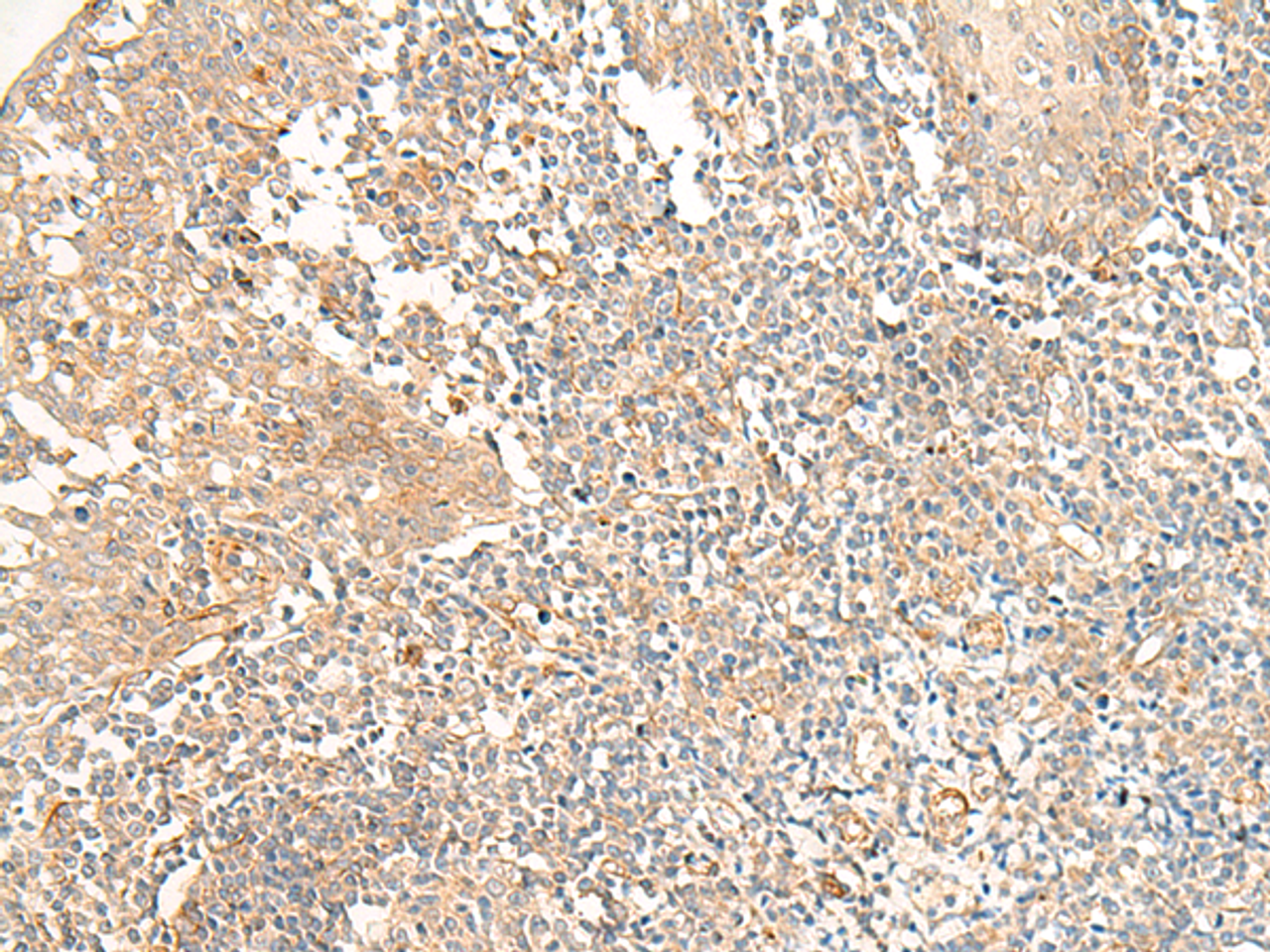 Immunohistochemistry of paraffin-embedded Human tonsil tissue  using PTGDR2 Polyclonal Antibody at dilution of 1:30(×200)