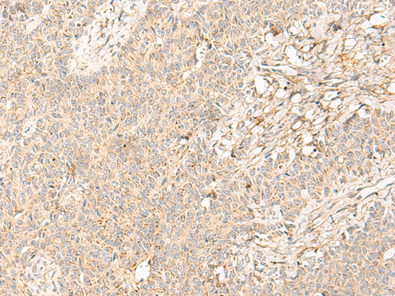 Immunohistochemistry of paraffin-embedded Human ovarian cancer tissue  using PTGDR2 Polyclonal Antibody at dilution of 1:30(×200)