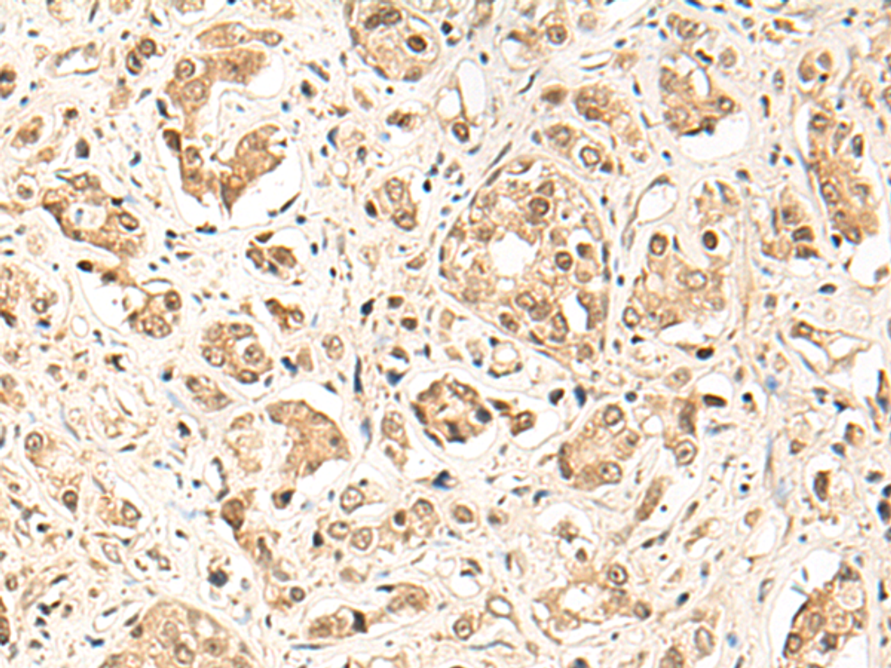 Immunohistochemistry of paraffin-embedded Human prost ate cancer tissue  using GPR139 Polyclonal Antibody at dilution of 1:50(×200)