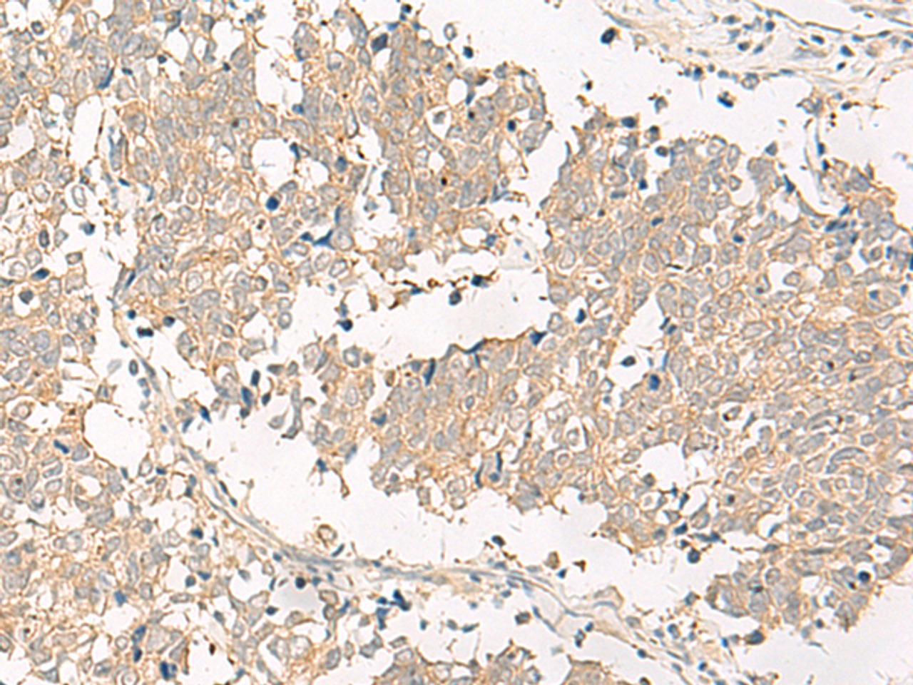 Immunohistochemistry of paraffin-embedded Human lung cancer tissue  using GPR161 Polyclonal Antibody at dilution of 1:40(×200)