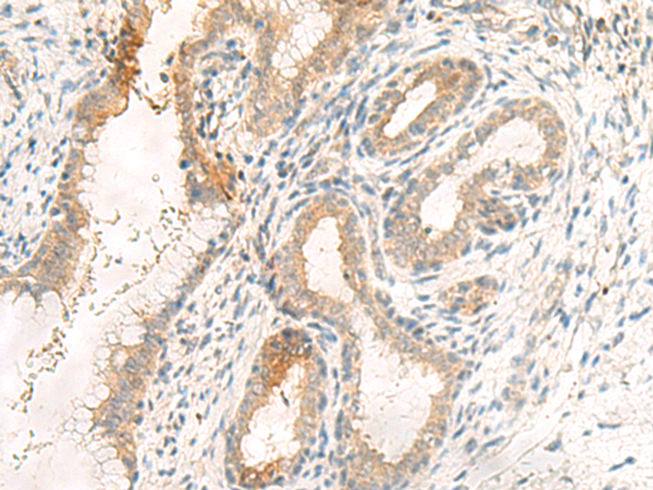Immunohistochemistry of paraffin-embedded Human cervical cancer tissue  using GPR89A/GPR89B Polyclonal Antibody at dilution of 1:25(×200)